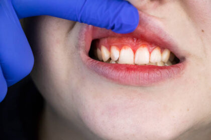 Understanding Gum Disease and Its Impact on Oral Health