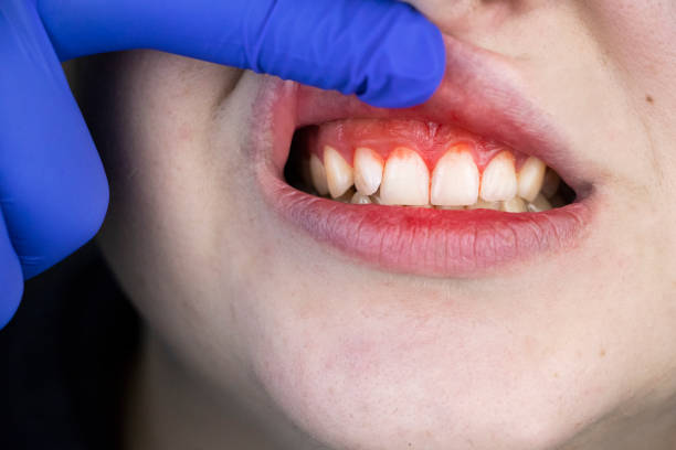 Understanding Gum Disease and Its Impact on Oral Health