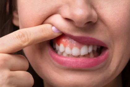 Understanding What Causes Gum Disease and how to Prevent it
