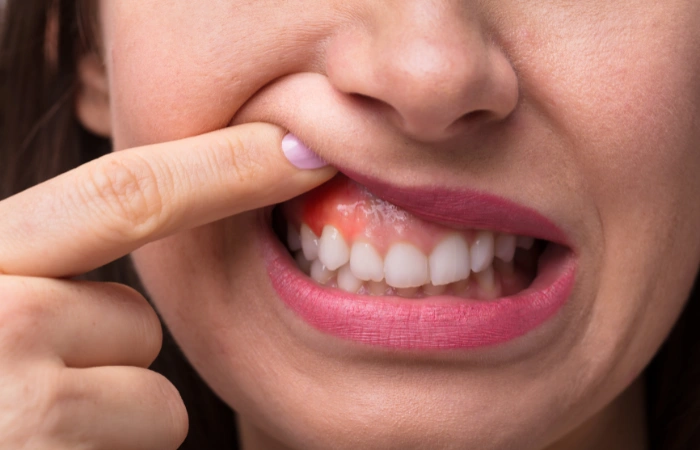 Understanding What Causes Gum Disease and how to Prevent it