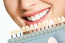 Veneers and Oral Health