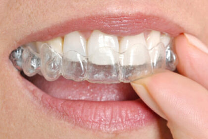 What’s New in Clear Aligners?