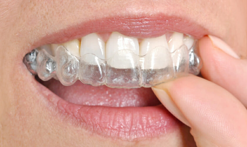 What’s New in Clear Aligners?