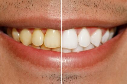 Do Natural Remedies for Teeth Whitening Work?