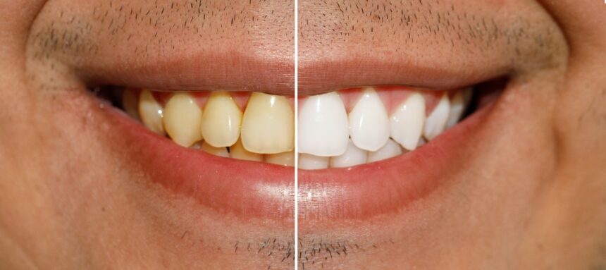 Do Natural Remedies for Teeth Whitening Work?