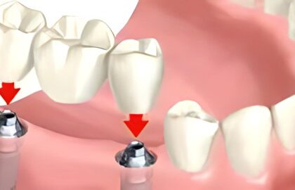 The Advantages of Choosing a Dental Bridge Over Other Tooth Replacement Options