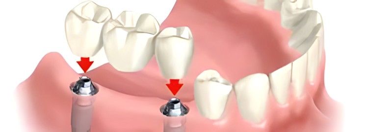 The Advantages of Choosing a Dental Bridge Over Other Tooth Replacement Options