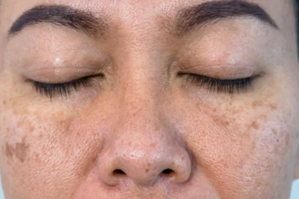 Why Is Your Skin So Dry? Top Causes Explained