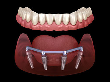 6 Leading Dental Implant Providers In Palm Beach County