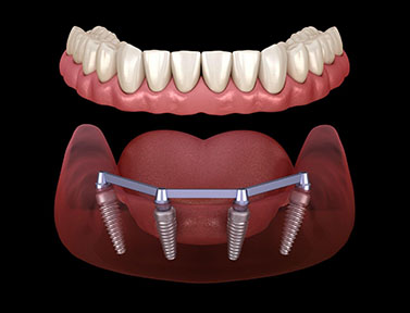 6 Leading Dental Implant Providers In Palm Beach County