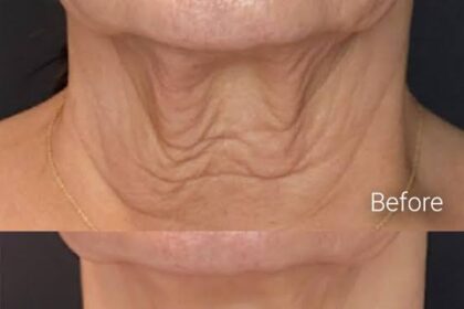 How to Compare Non-Surgical Skin Tightening Options