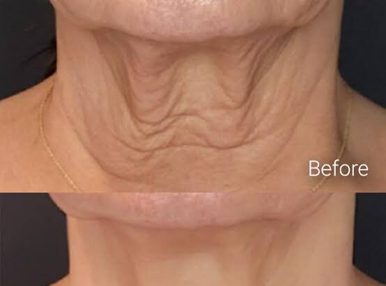 How to Compare Non-Surgical Skin Tightening Options