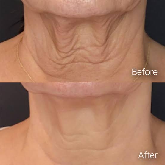 How to Compare Non-Surgical Skin Tightening Options